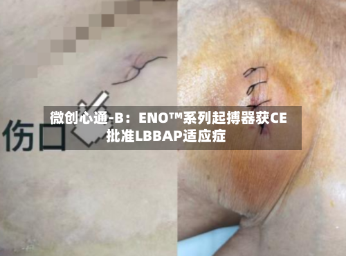 微创心通-B:ENO™系列起搏器获CE批准LBBAP适应症-第2张图片
